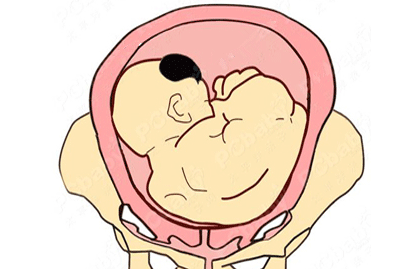 警惕导致胎儿横位的七种