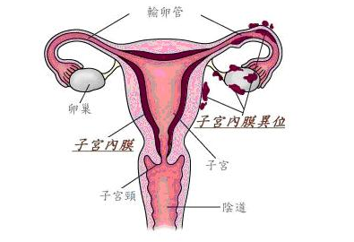 几招教你辨别子宫内膜异位症的症