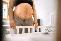 孕腹宝真的能淡化妊娠纹吗？